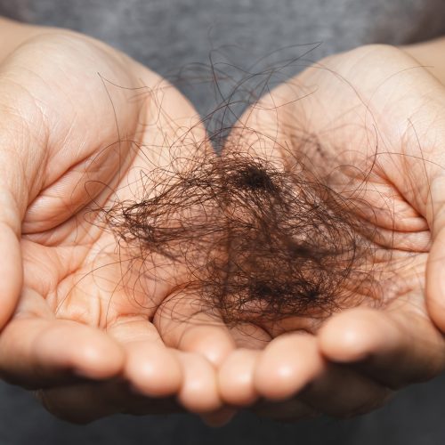 Women with hair loss Because she is allergic to shampoo