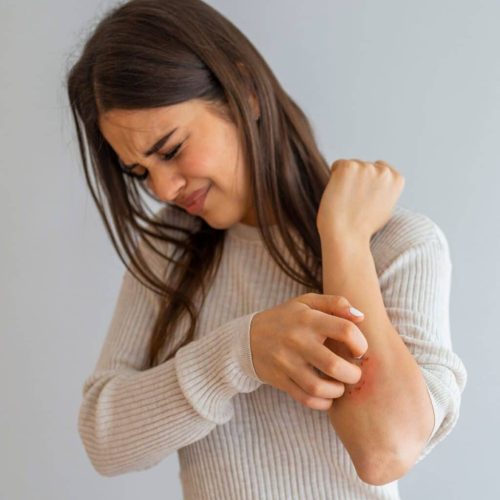 woman-with-eczema-1024x1024
